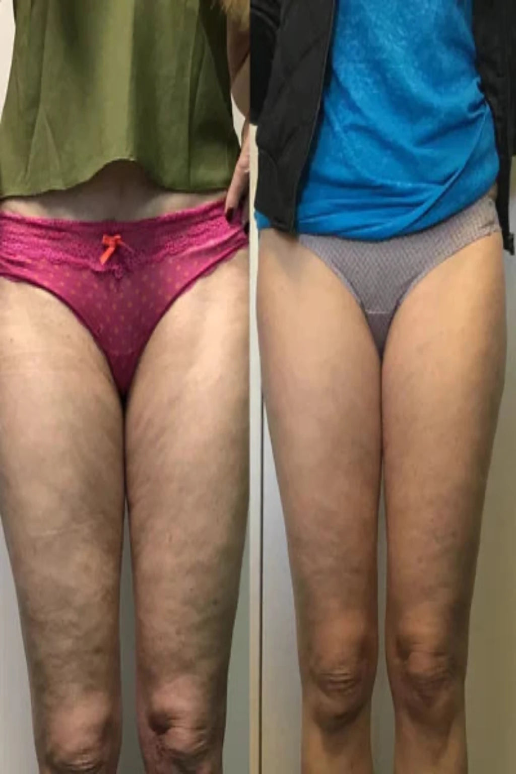 Vacutone Firm & Sculpt Pro™